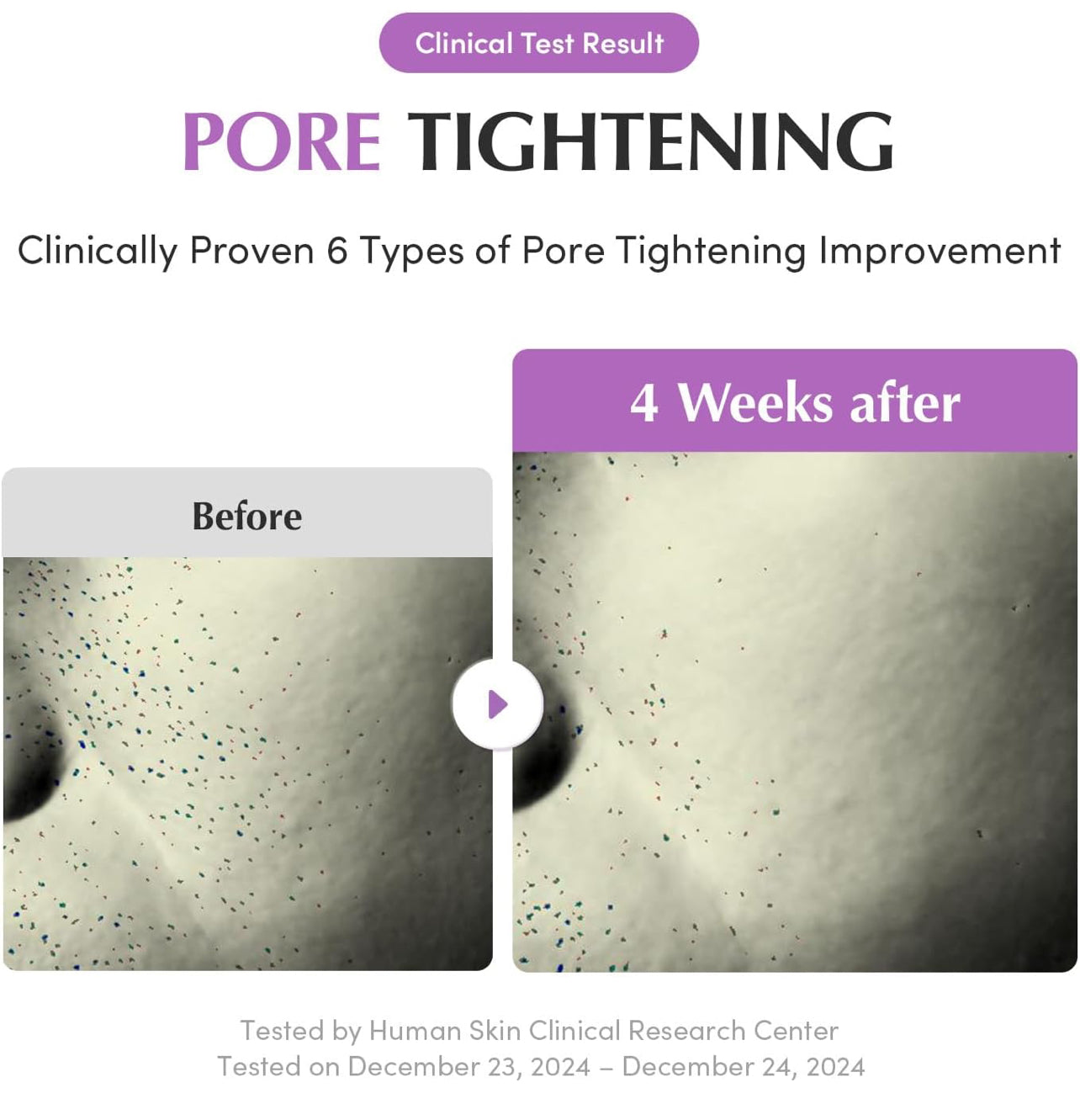 Before and after clinical images of pore tightening results after 4 weeks of using Purple PDRN Serum