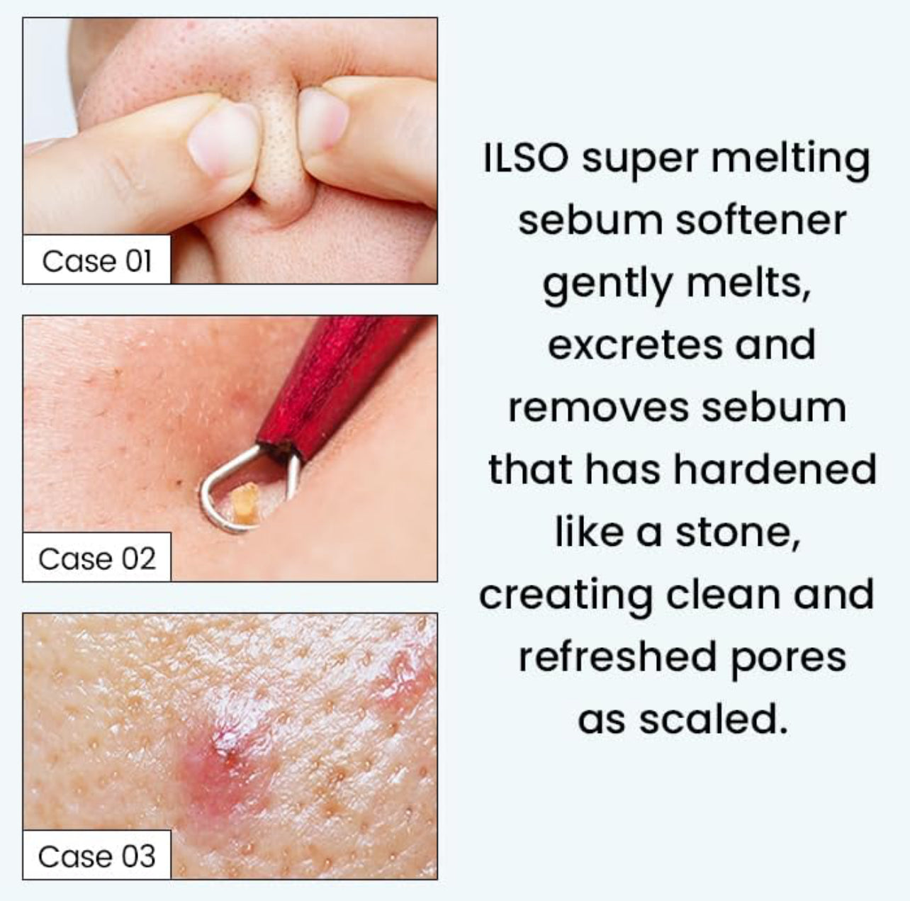 ILSO Super Melting SEBUM Softener + 1/3 Saving Cotton Pad ilso Skincare ilso
