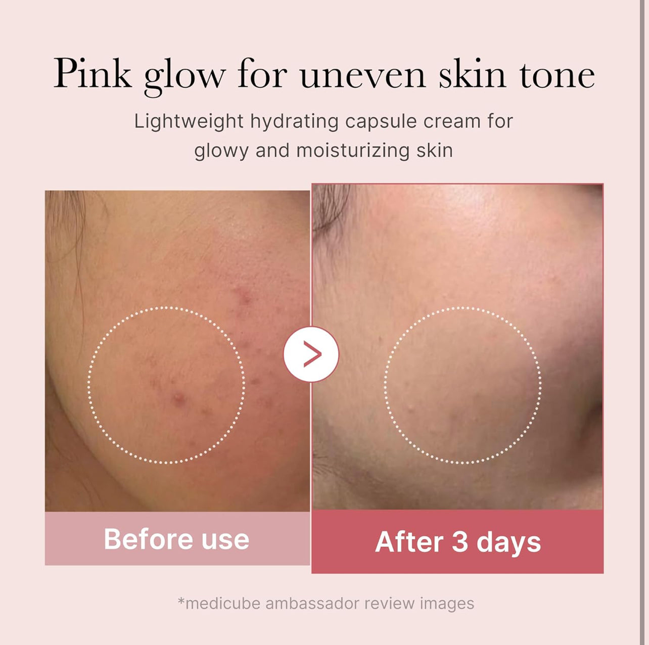 Before and after image showing improvement in uneven skin tone after 3 days of using Medicube PDRN Pink Collagen Cream